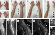 Hirayama Disease… Cervical Flexion Myelopathy