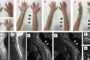 Hirayama Disease… Cervical Flexion Myelopathy
