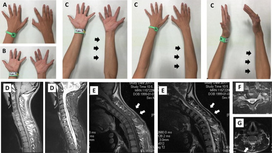 Hirayama Disease… Cervical Flexion Myelopathy